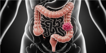 Câncer de intestino aos 50: por que o caso de Preta Gil nos preocupa tanto?