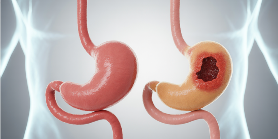Dor abdominal intensa e azia frequente podem indicar a presença de uma úlcera estomacal. / Ilustração Cortesia Editorial Ideia